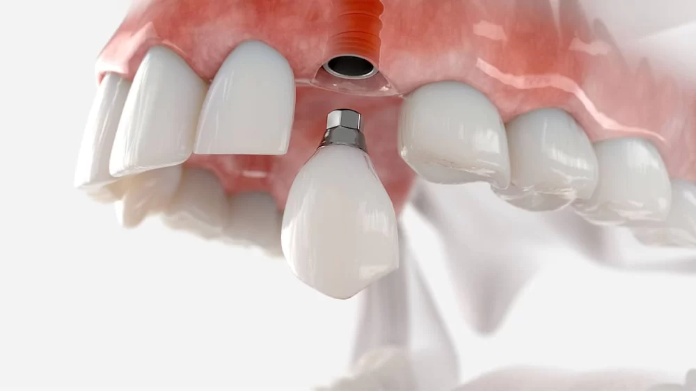 The Top Benefits of Dental Implants Over Dentures: Why You Should Choose Implants