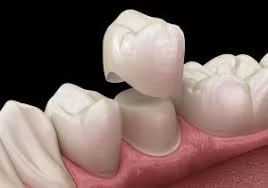 How to Avoid Dental Crowns with Proper Care: Essential Tips for Healthy Teeth