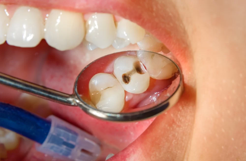 How to Treat a Cavity Naturally at Home: Effective Remedies You Can Try