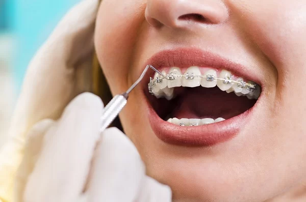 How to Choose Between Traditional Braces and Clear Aligners: A Complete Guide