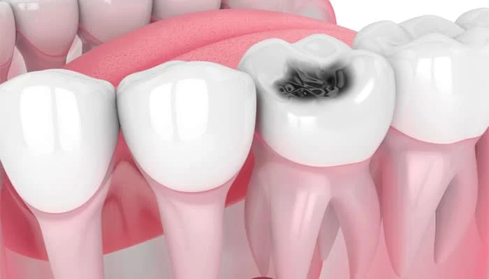 Best Treatment Options for Cavities in Teeth with Fillings