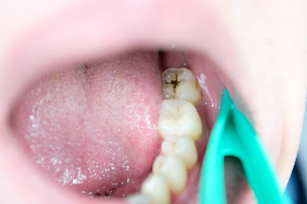 Should You Treat Cavities in Baby Teeth That Are About to Fall Out?