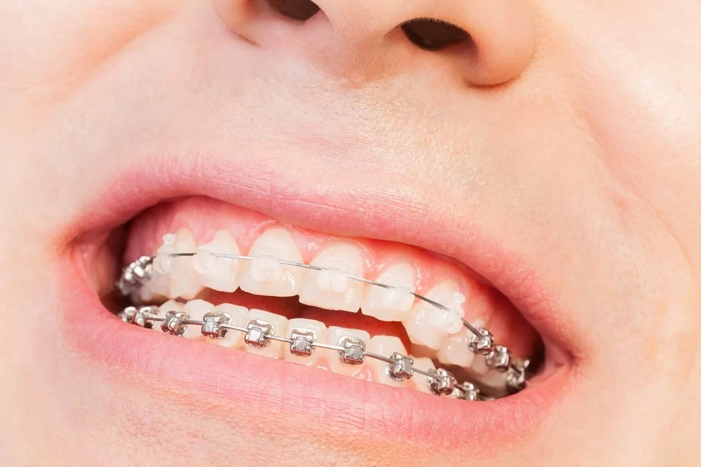 Effective Orthodontic Treatments for Crossbite – Best Solutions for a Perfect Smile