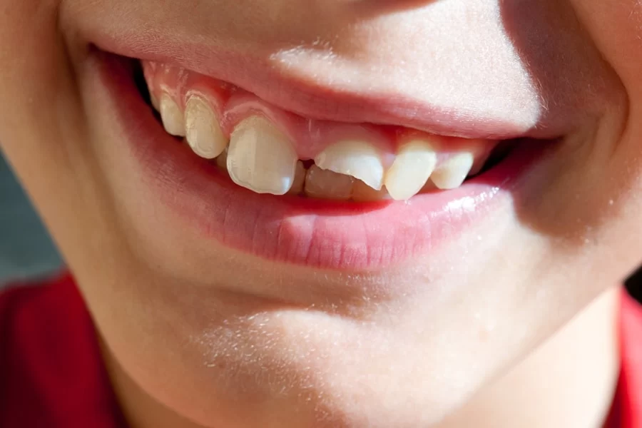 How to Handle a Cracked Dental Bridge: Expert Advice and Solutions