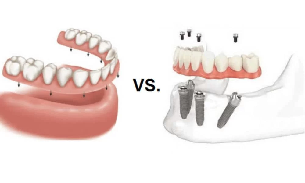 The Cost of Dental Implants Versus Dentures: Which Is Right for You?