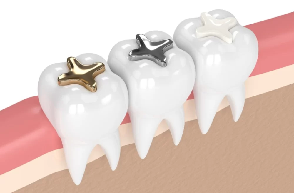 What to Do if You Lose a Dental Filling: Immediate Steps and Solutions