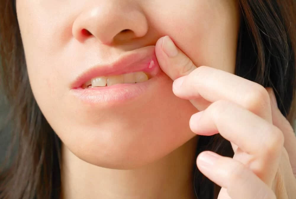 How to Treat Mouth Sores or Ulcers Before Seeing a Dentist