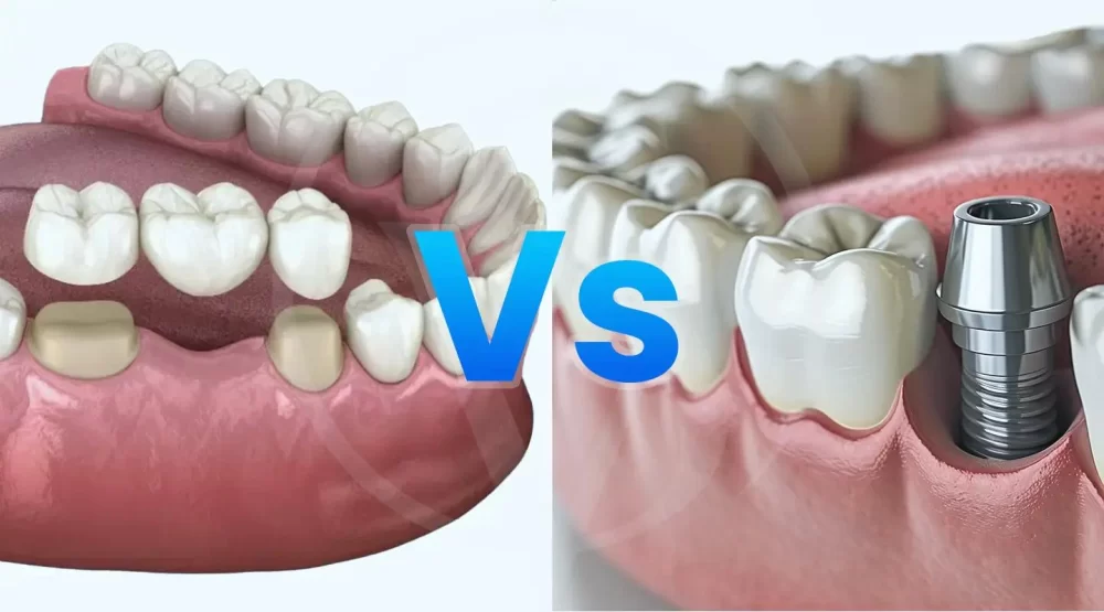 Why Choose Dental Implants Over Bridges - Benefits Explained