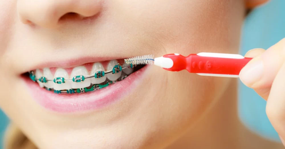 How to Help Your Child Maintain Oral Health During Braces: Expert Tips for Parents