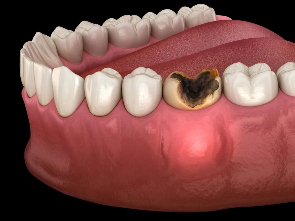 First Aid for an Abscessed Tooth Until You Get to the Dentist