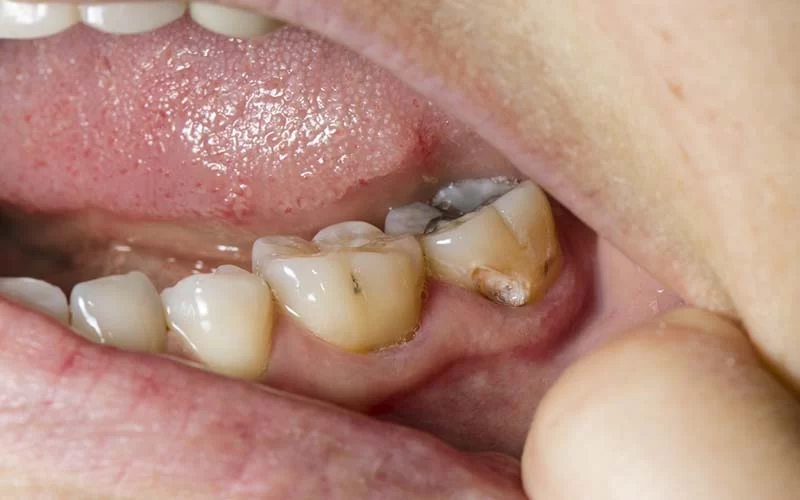 How to Avoid Tooth Decay: Tips for Preventing Cavities and Maintaining Healthy Teeth