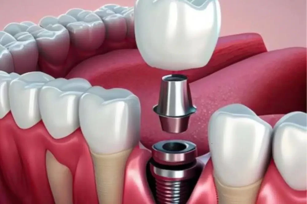 How to Take Care of Dental Implants: Essential Tips for Long-Term Success