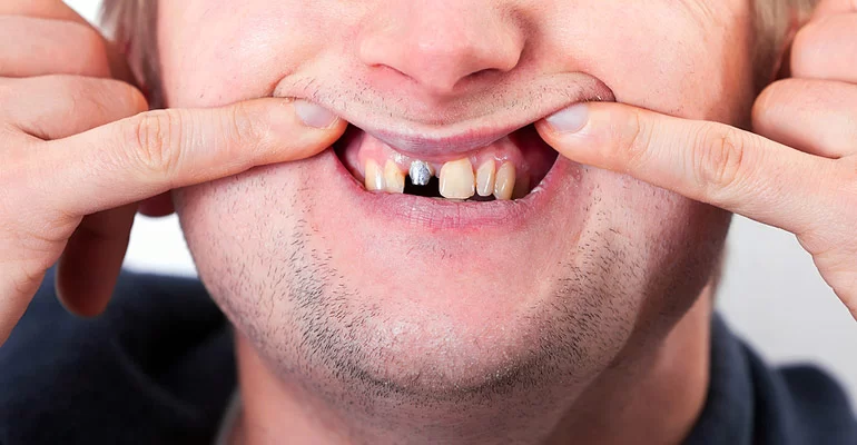 What to Do When a Dental Crown Falls Off: Steps to Fix It