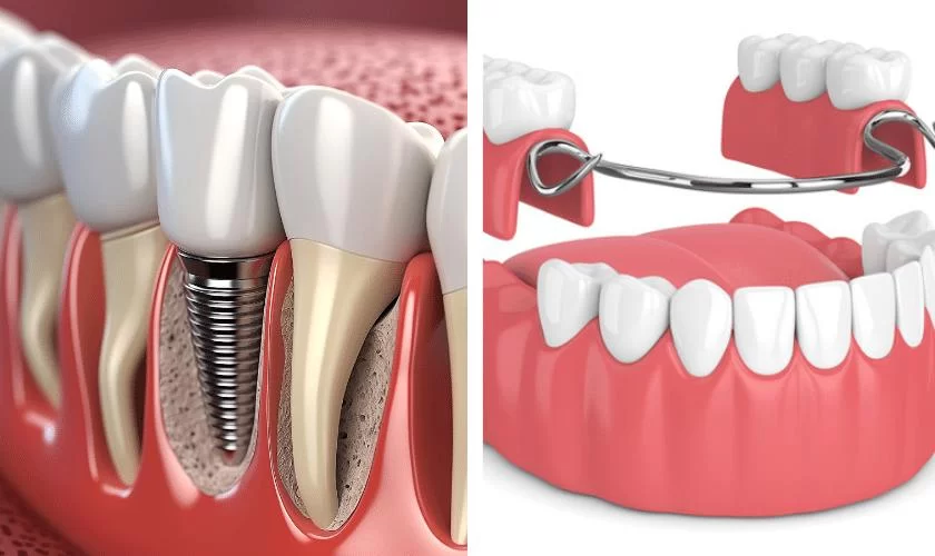 Choosing Between Dental Implants and Dentures: Which Is Right for You?