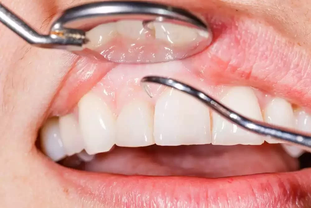 How to Maintain Healthy Gums: Essential Tips and Habits