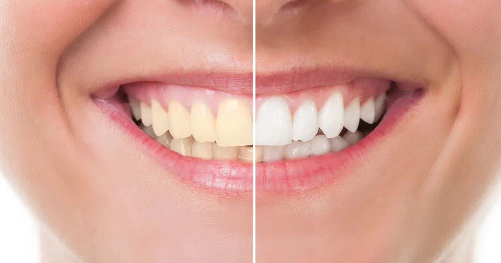 Is HiSmile Dentist Approved? Understanding Its Effectiveness