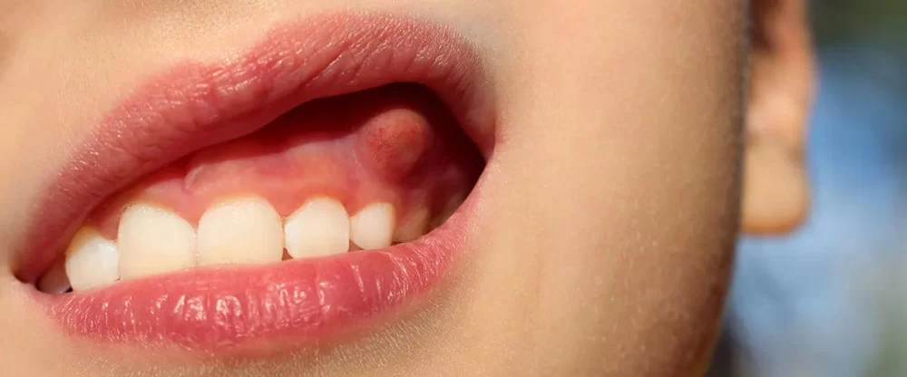 Do Dentists Drain Abscesses? A Guide to Dental Abscess Treatment