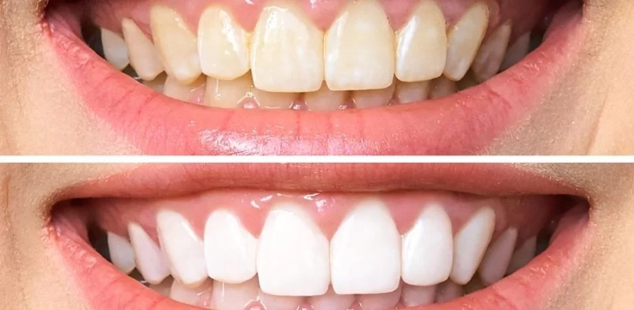 Do Dentists Bleach Teeth? Everything You Need to Know About Teeth Whitening