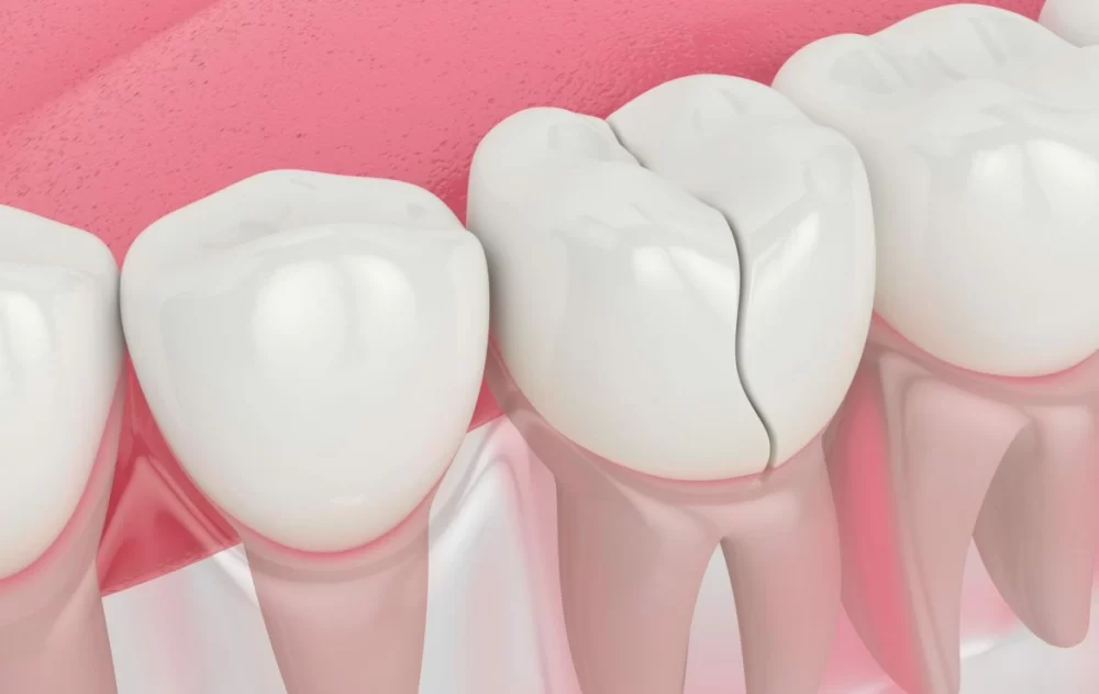 How to Fix Cracked Teeth with Dental Crowns: Effective Solutions for Your Smile