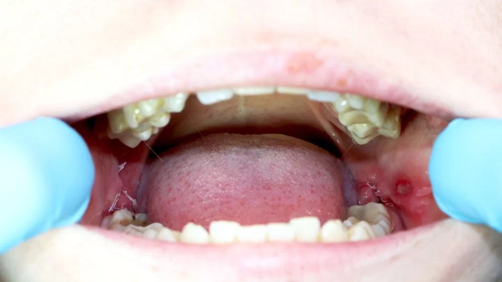 Tips for Taking Care of Wisdom Teeth: Essential Tips for Healthy Teeth