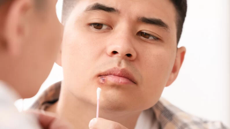 Can You Go to the Dentist with a Cold Sore? Understanding the Risks