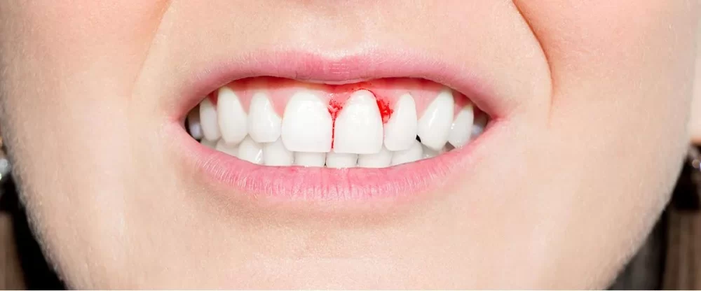 What to Do for Sudden Bleeding Gums: Causes and Remedies for Relief
