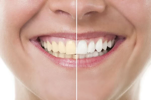 How to Get Rid of Yellow Teeth Naturally at Home
