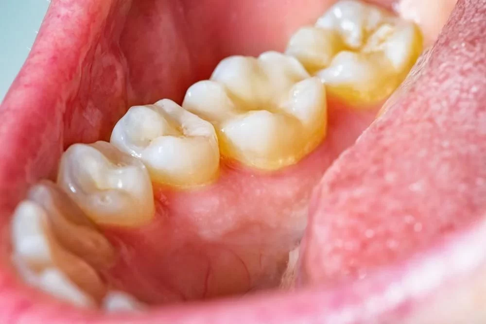 How to Get Rid of Plaque Buildup Naturally and Effectively