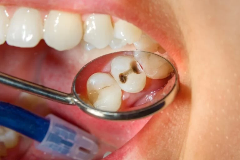 How to Prevent Early Childhood Tooth Decay – Essential Tips for Parents