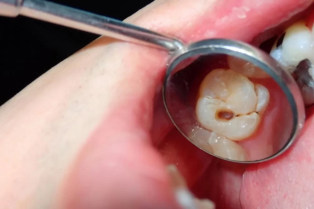 How to Treat a Cracked Tooth and Prevent Further Damage