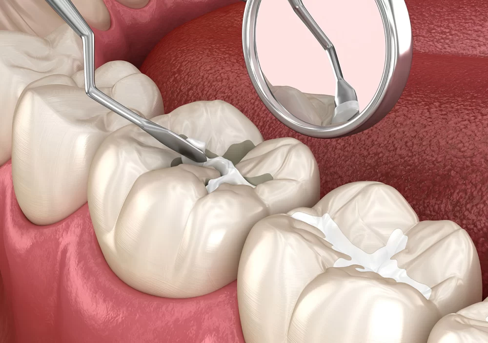 The Role of Dental Sealants in Cavity Prevention for Kids