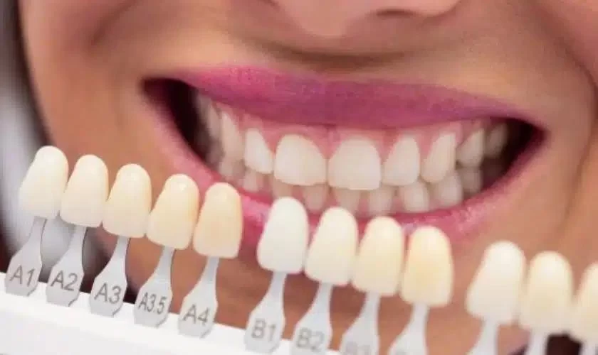 How to Fix a Loose Dental Veneer: Expert Tips and Solutions