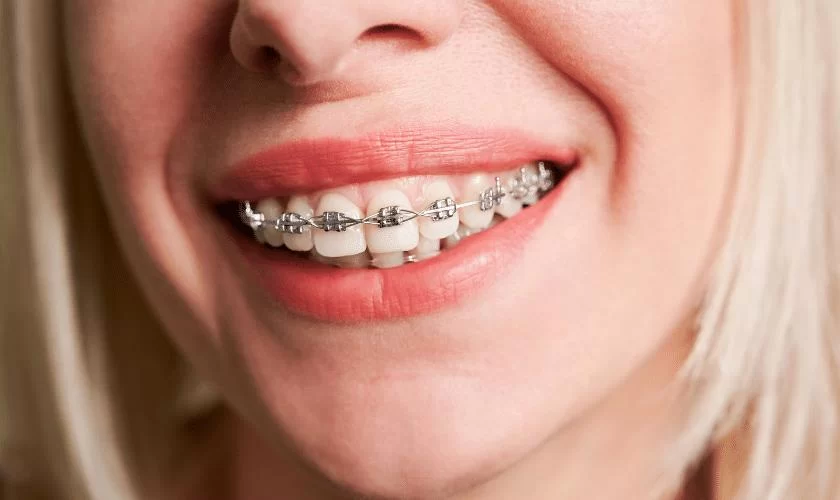 How to Maintain Oral Health After Braces – Tips for a Lasting Smile