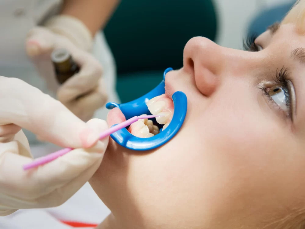 The Benefits of Getting Dental Sealants for Cavity Protection and Long-Term Oral Health