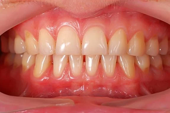 Best Treatments for Gum Disease: Effective Solutions for Healthy Gums