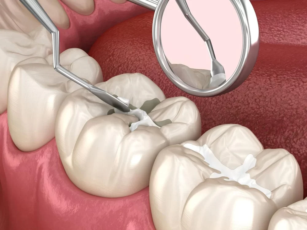 The Difference Between a Filling and a Crown: Which One Is Right for You?