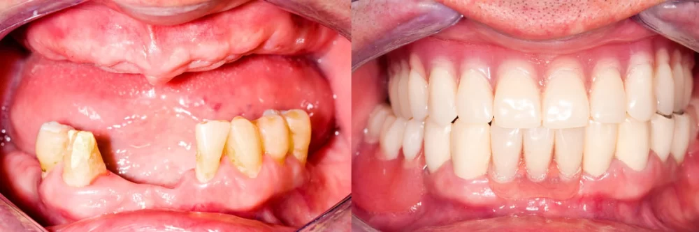 How to Manage Missing Teeth with Dental Prosthetics: Solutions for Your Smile