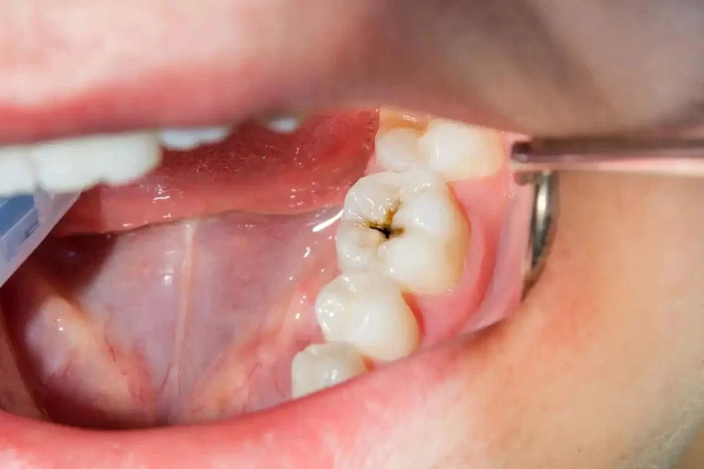 How to Treat a Cavity Naturally: Effective Methods for Tooth Health