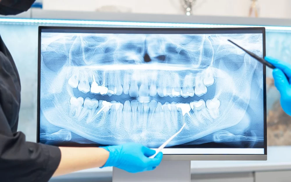Dental X-Rays: What You Need to Know Before Your Appointment