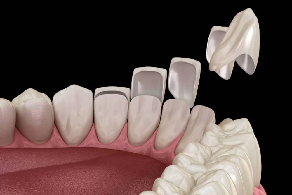 How to Fix a Loose Dental Veneer: Quick Solutions and Tips