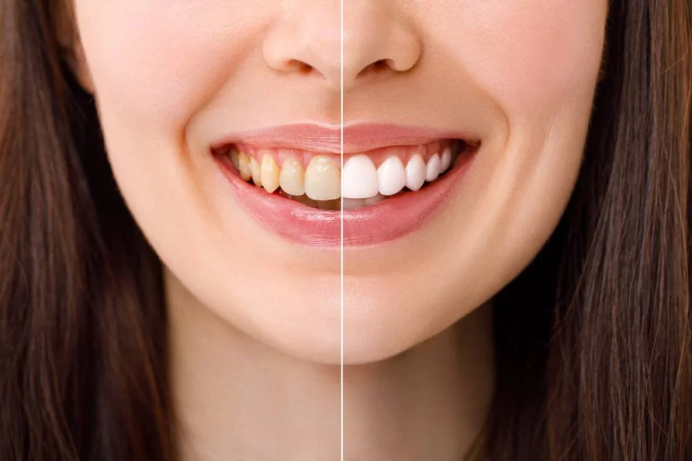 How to Safely Whiten Your Teeth at Home Without Harm