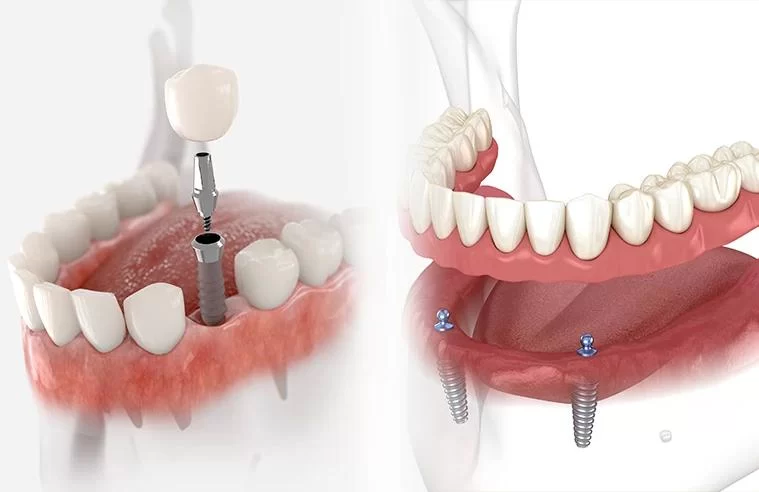 The Cost of Dental Implants Versus Dentures: Which is the Better Option for You?
