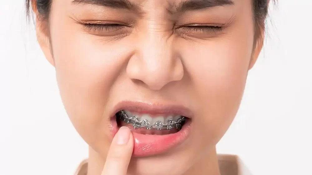 How Long Do You Have to Wear Braces? What to Expect