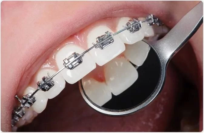 Is a Root Canal Necessary? What Are the Benefits?