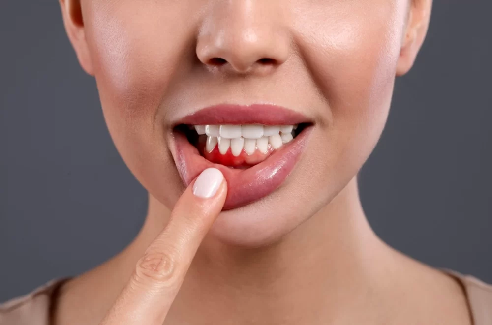 How to Prevent Gum Disease and Keep Your Gums Healthy