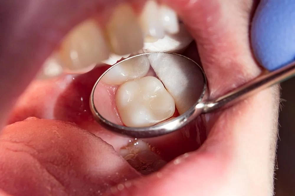 How to Prevent Cavities from Developing