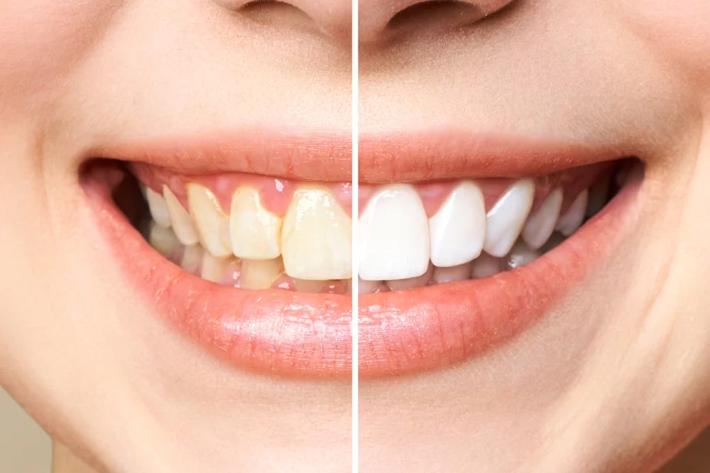 Can Teeth Whitening Damage Your Teeth?