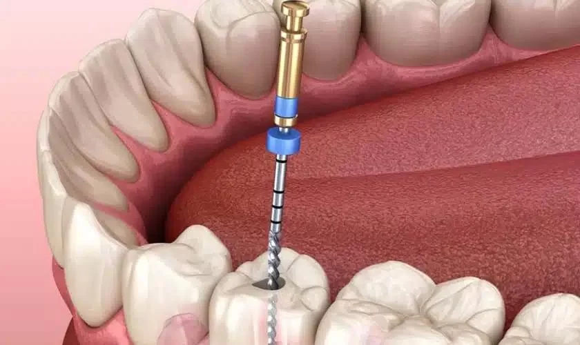 How to Prepare for a Root Canal Procedure: A Complete Guide