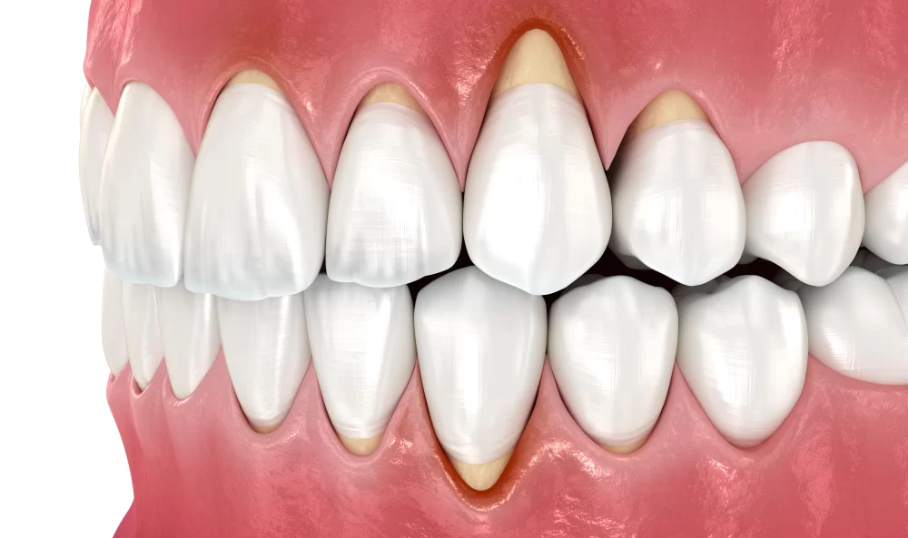 How to Protect Your Gums from Recession: Effective Tips and Prevention