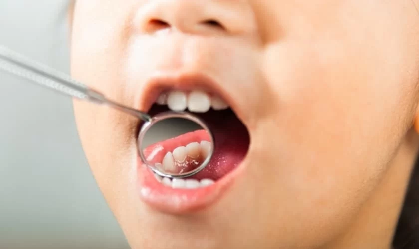 How to Treat Your Child's First Cavity: Essential Steps and Expert Advice